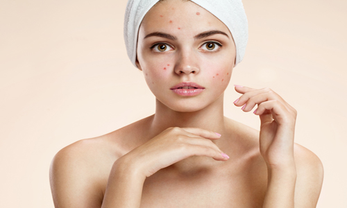 3 medidas que te ayudarán a combatir el acné