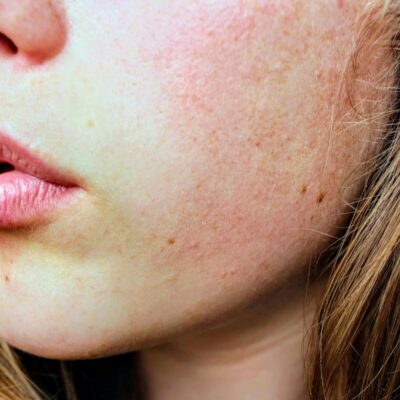 Xerosis o piel muy seca: síntomas, causas y tratamiento